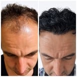 نتائج زراعة الشعر FUE قبل وبعد في Alpha Beauty Hannover، كثافة شعر محسنة