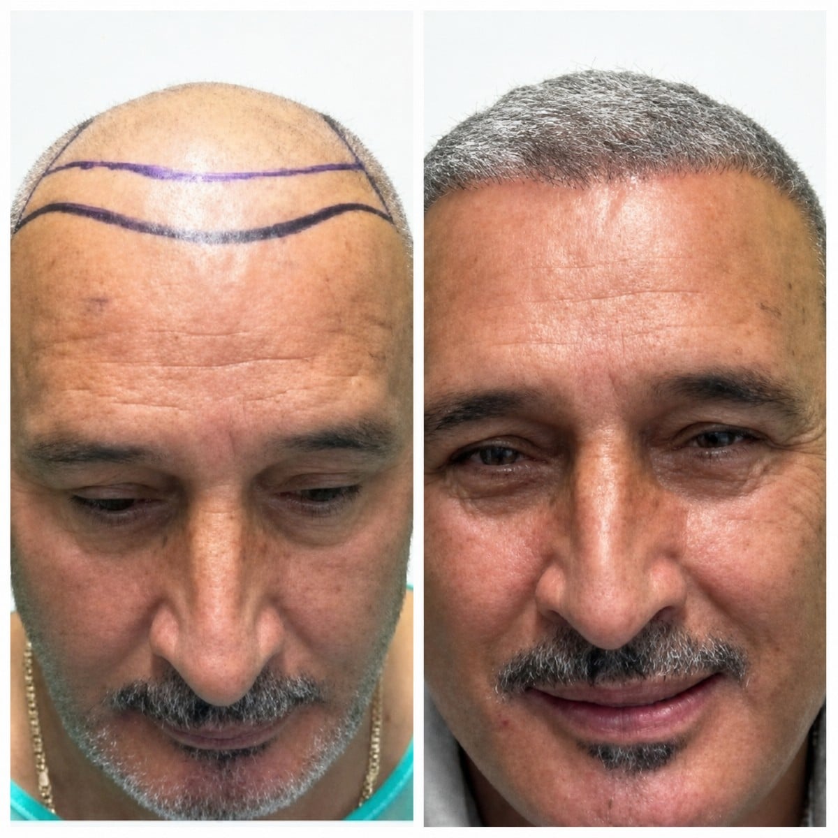 نتائج زراعة الشعر FUE قبل وبعد في Alpha Beauty Hannover، استعادة خط الشعر للرجال