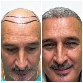 نتائج زراعة الشعر FUE قبل وبعد في Alpha Beauty Hannover، استعادة خط الشعر للرجال