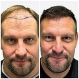 Before and after FUE hair transplant results at Alpha Beauty Hannover, restored hairline in male
