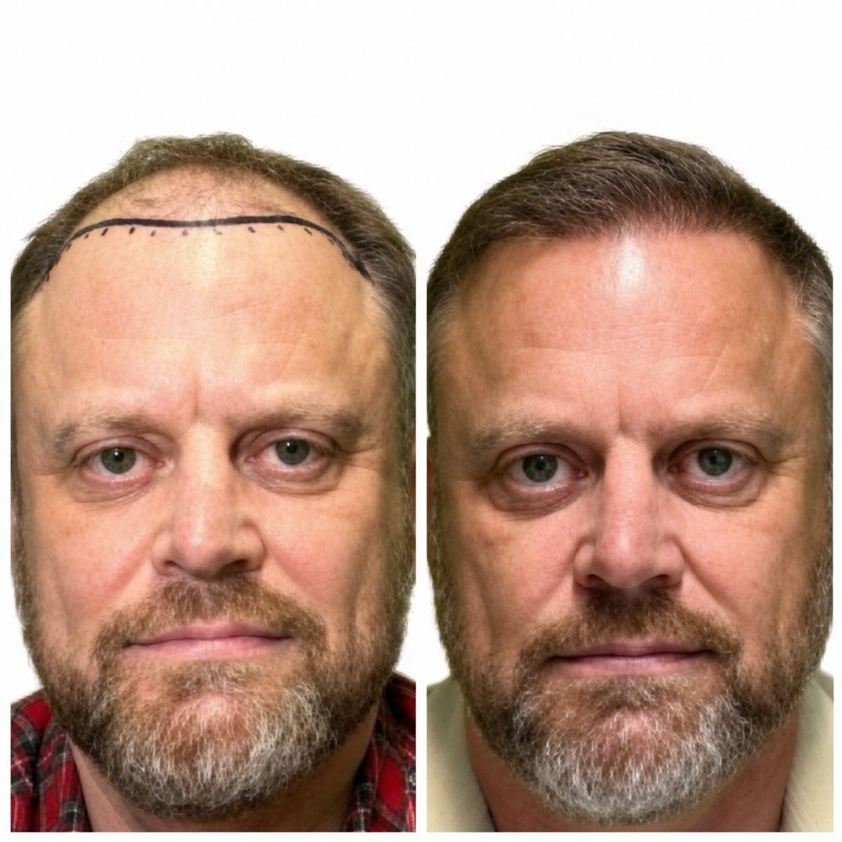 نتائج زراعة الشعر قبل وبعد في Alpha Beauty Hannover، استعادة خط الشعر الطبيعي