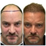 Before and after hair transplant results at Alpha Beauty Hannover, restored natural hairline