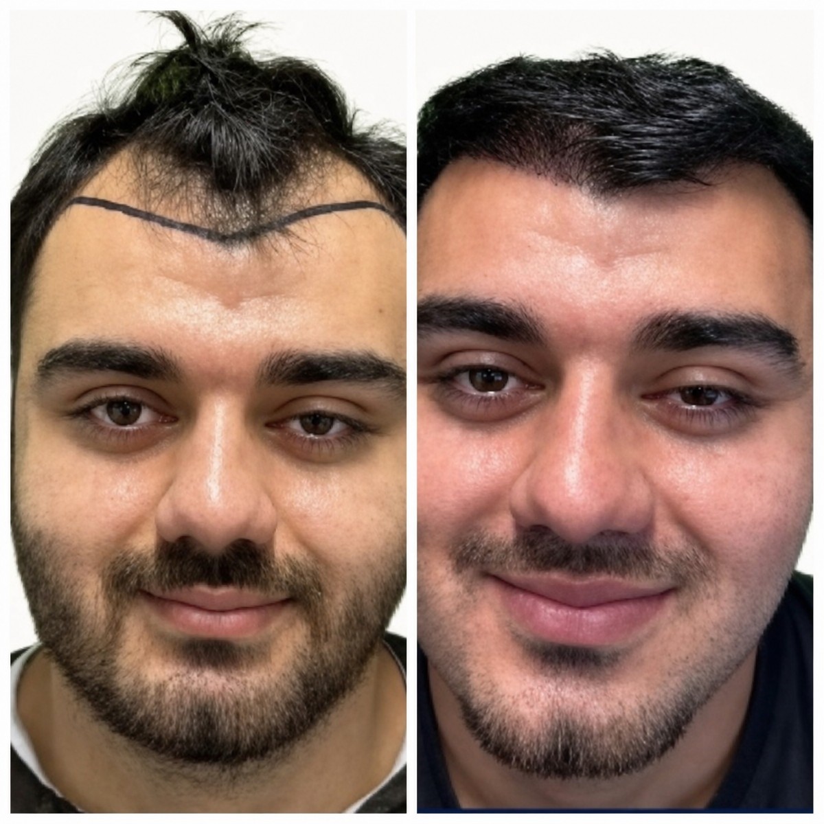 Resultados de trasplante capilar antes y después en Alpha Beauty Hannover, línea mejorada