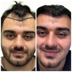 Before and after hair transplant results at Alpha Beauty Hannover, improved hairline in male patient