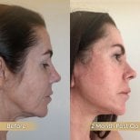 Vorher-nachher-Ergebnis Deep Plane Facelift bei Dr. Safa Manav Clinic, sichtbare Verjüngung
