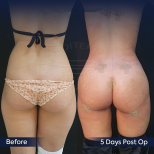 Vorher-nachher-Ergebnis Brazilian Butt Lift bei Dr. Safa Manav Clinic, sichtbar geformte Kurven