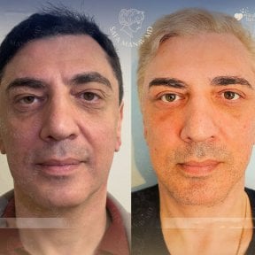 Facelift Vorher-Nachher-Ergebnisse in der Dr. Safa Manav Klinik, sichtbare Verjüngung