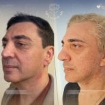 Facelift Vorher-Nachher-Ergebnisse in der Dr. Safa Manav Klinik, sichtbare Verjüngung