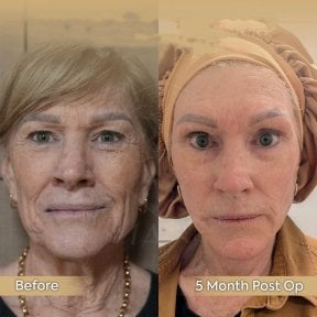 Deep Plane Facelift Vorher-Nachher-Ergebnis bei Dr. Safa Manav Clinic, 5 Monate post-op