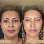 Vorher-nachher-Ergebnis Deep Plane Facelift bei Dr. Safa Manav Clinic, 6 Wochen postoperativ