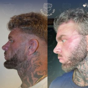 Vorher-nachher-Facelift-Ergebnisse in der Dr. Safa Manav Klinik, verbesserte Gesichtskontur