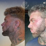 Vorher-nachher-Facelift-Ergebnisse in der Dr. Safa Manav Klinik, verbesserte Gesichtskontur