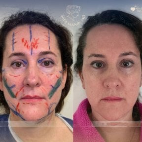 Vorher-nachher-Ergebnisse Deep Plane Facelift bei Dr. Safa Manav Clinic, Gesichtsverjüngung