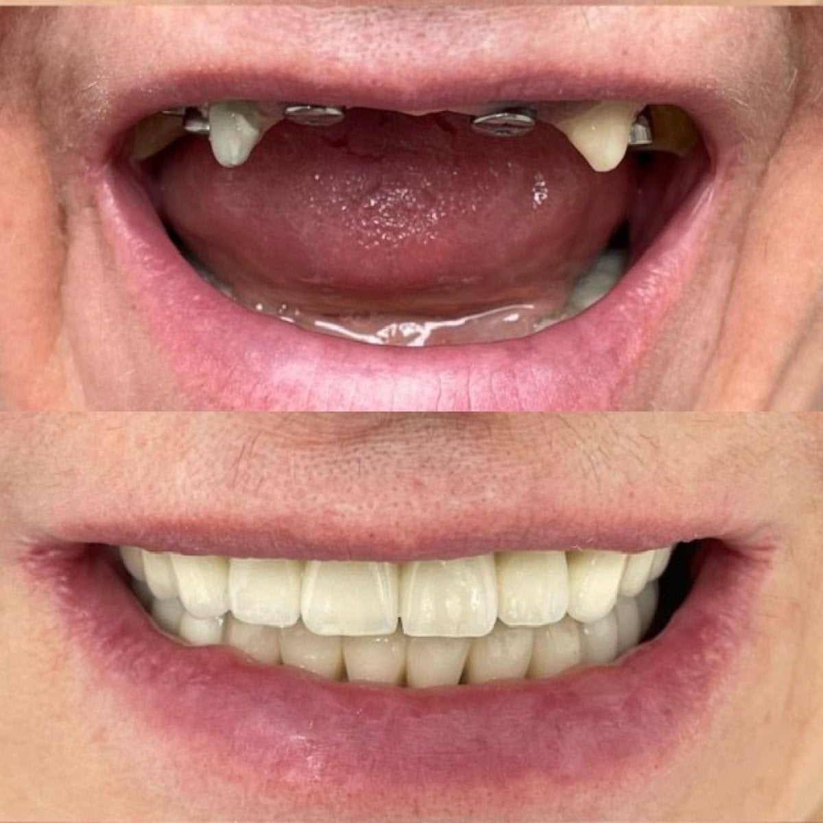 نتائج قبل وبعد تركيب تيجان الأسنان في عيادة VerMax Dental Clinic، ابتسامة محسنة