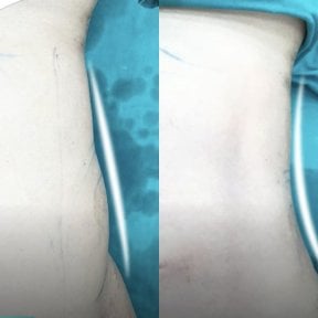 Before and after abdominal liposuction results at Munare Clinic showing slimmer waist contour