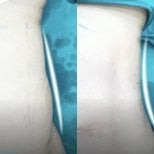 Before and after abdominal liposuction results at Munare Clinic showing slimmer waist contour