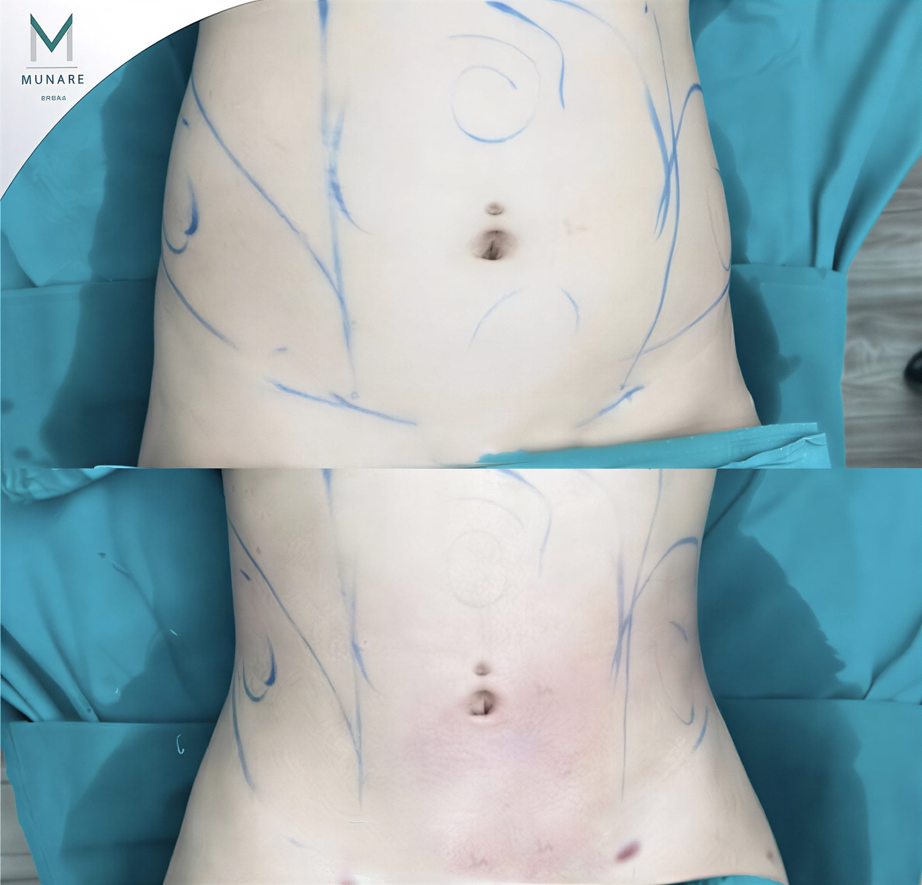 Resultados de liposucción abdominal antes y después en Munare Clinic con cintura más delgada