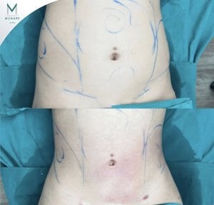 Before and after abdominal liposuction results at Munare Clinic showing slimmer waistline