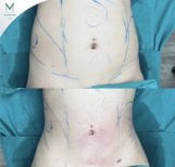 Before and after abdominal liposuction results at Munare Clinic showing slimmer waistline
