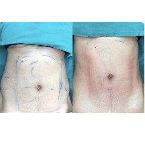 Before and after abdominal liposuction results at Munare Clinic, visible contour improvement