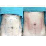 Before and after abdominal liposuction results at Munare Clinic, visible contour improvement