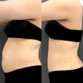 Before and after abdominal liposuction results at Munare Clinic, visible waist contour improvement