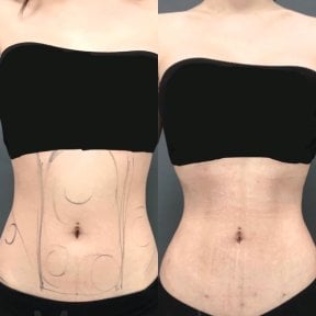 Before and after liposuction results on abdomen and waist at Munare Clinic, body contouring