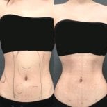 Before and after liposuction results on abdomen and waist at Munare Clinic, body contouring
