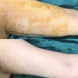 Vorher-nachher-Ergebnis Oberarm-Liposuktion bei Munare Clinic, verbesserte Kontur