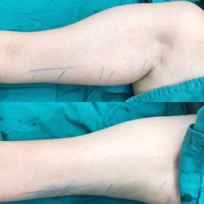 نتائج شفط دهون الذراع العلوية في عيادة Munare – تحسين شكل الذراع