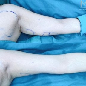 نتائج شفط دهون الذراع العلوية قبل وبعد في عيادة Munare تظهر ذراعين أنحف
