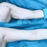 نتائج شفط دهون الذراع العلوية قبل وبعد في عيادة Munare تظهر ذراعين أنحف