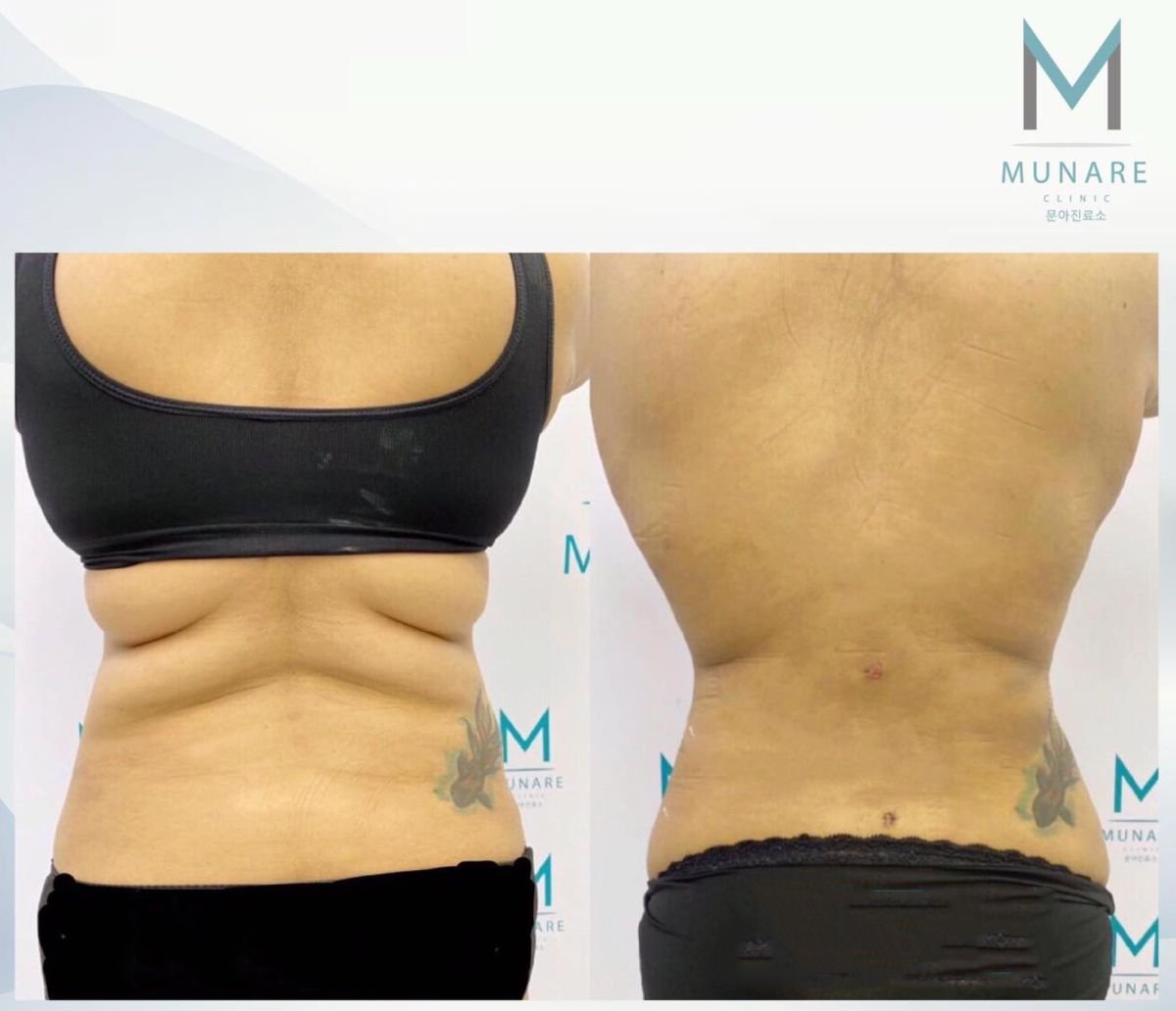 Resultado de liposucción en 5 áreas corporales antes y después en Munare Clinic – contorno mejorado