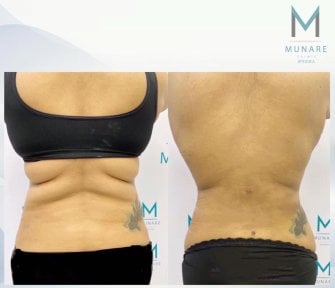 Before and after liposuction (5 body areas) result at Munare Clinic – improved body contour