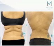 Before and after liposuction (5 body areas) result at Munare Clinic – improved body contour