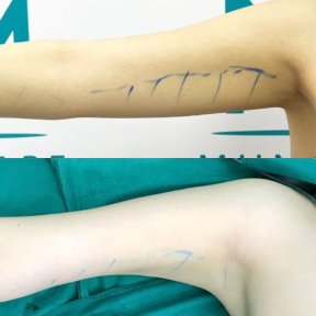 Vorher-nachher-Ergebnis Oberarmliposuktion bei Munare Clinic, verbesserte Armkontur