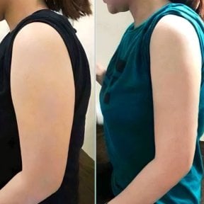 نتائج شفط دهون الذراع العلوية قبل وبعد في عيادة Munare، تحسين شكل الذراع