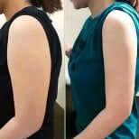 نتائج شفط دهون الذراع العلوية قبل وبعد في عيادة Munare، تحسين شكل الذراع