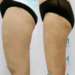 Résultats avant/après liposuccion des cuisses à la clinique Munare, amélioration visible du contour