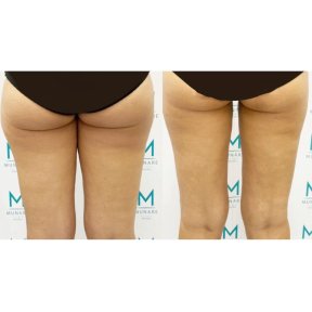 Résultats avant/après liposuccion des cuisses à la clinique Munare, contour amélioré