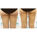Résultats avant/après liposuccion des cuisses à la clinique Munare, contour amélioré