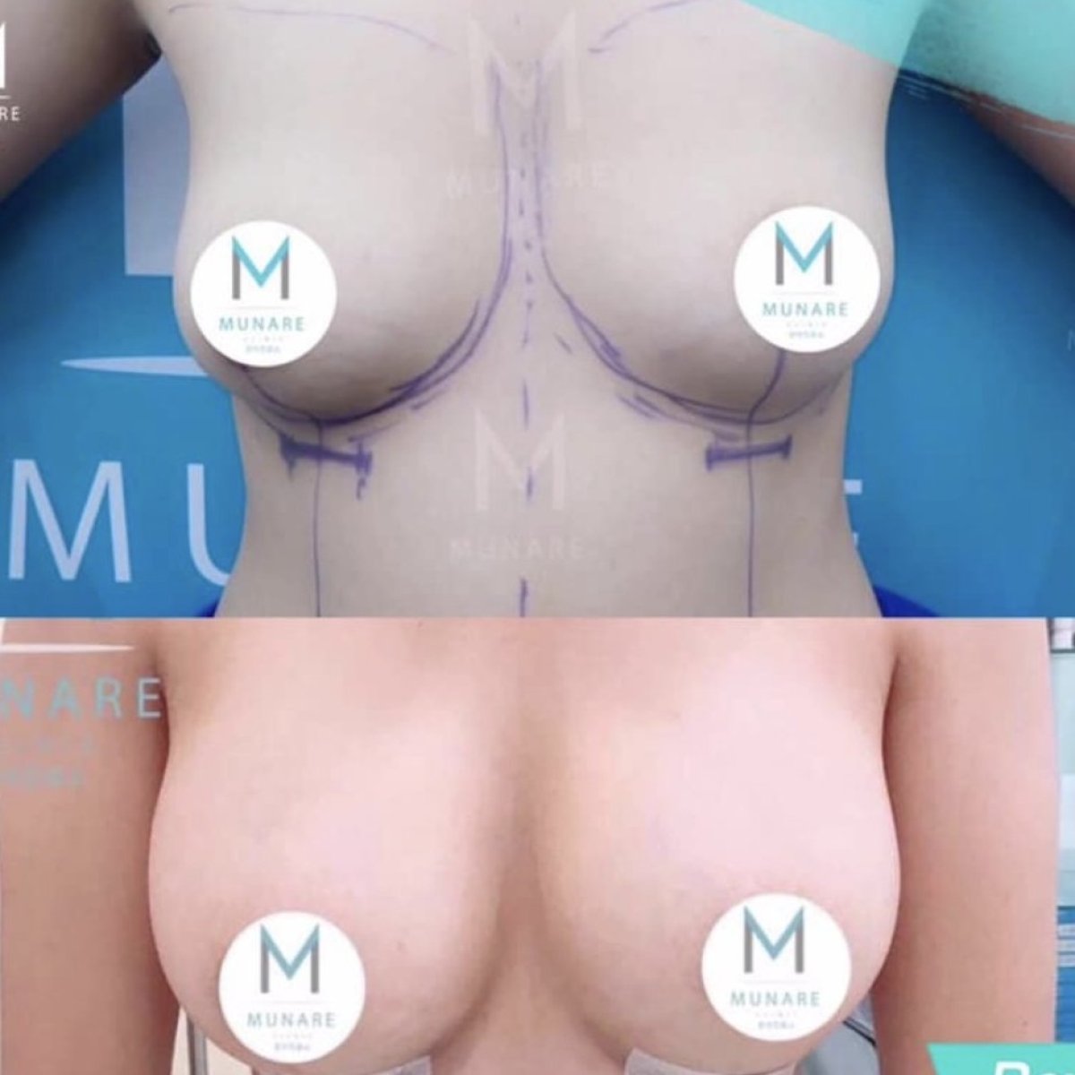 نتائج قبل وبعد تكبير الثدي في عيادة Munare، زيادة حجم الثدي