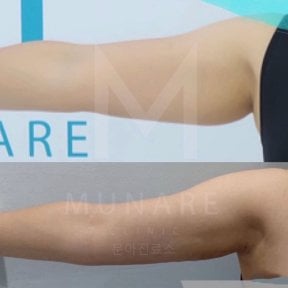 نتائج شفط دهون الذراع العلوية قبل وبعد في عيادة Munare، تحسين شكل الذراع
