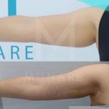 نتائج شفط دهون الذراع العلوية قبل وبعد في عيادة Munare، تحسين شكل الذراع