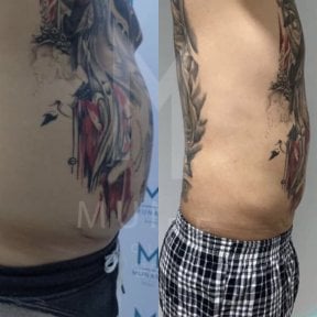 Before and after abdominal liposuction results at Munare Clinic, visible fat reduction