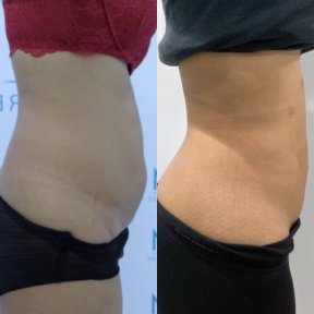 Before and after abdominal liposuction results at Munare Clinic – slimmer waist contour