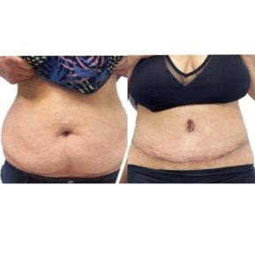 Before and after liposuction results at Yanhee International Hospital, improved abdominal contour