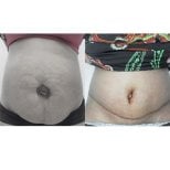 Before and after liposuction results at Yanhee International Hospital, improved abdominal contour