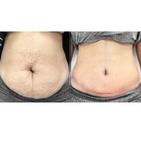 Before and after liposuction results at Yanhee International Hospital, improved abdominal contour