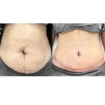 Before and after liposuction results at Yanhee International Hospital, improved abdominal contour